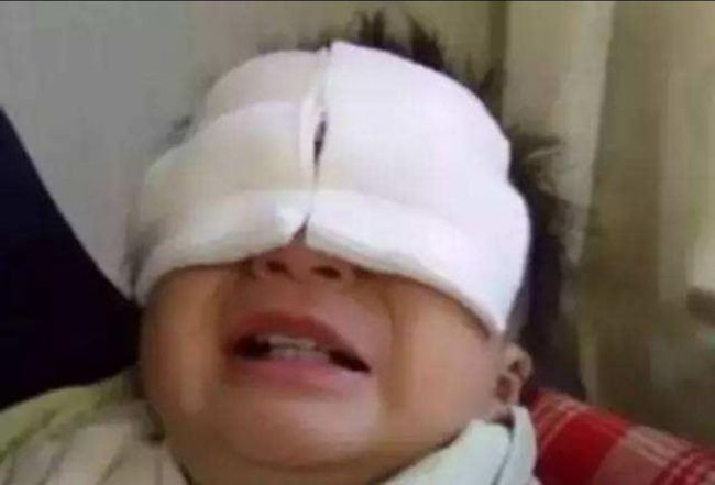 偏方差点让新生儿失明紧急施救让孩子重见光明:出生仅27天