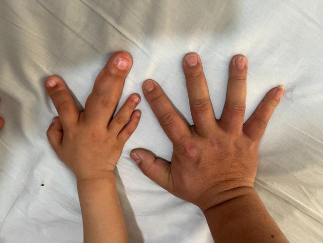 男童手指粗过成年男性系患罕见病：巨指会一直生长，越长越快！