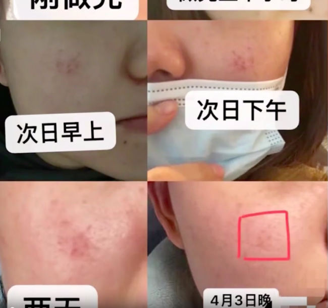 网友曝在赫莲娜做护理致脸部烧伤 店员：美容师已停职半月