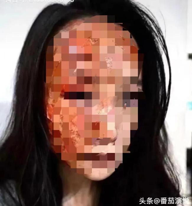 台湾一女子遭热汤淋头 面部三分之二被严重烫伤  