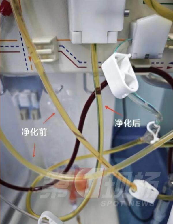 23岁糖尿病男子血脂爆表 血液净化洗出一大袋黄“油”